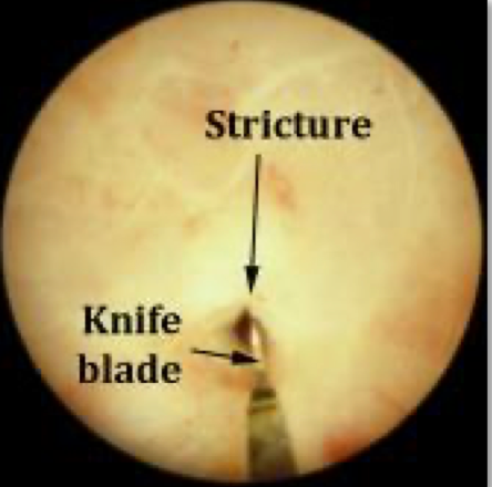 Cystoscopic view of urethral stricture with pinhole lumen during surgery, with stricture and knife blade labelled